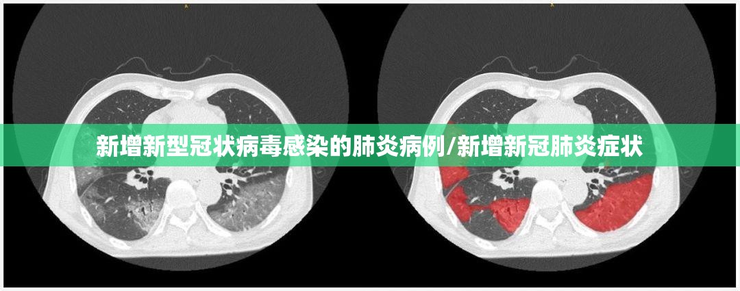 新增新型冠状病毒感染的肺炎病例/新增新冠肺炎症状