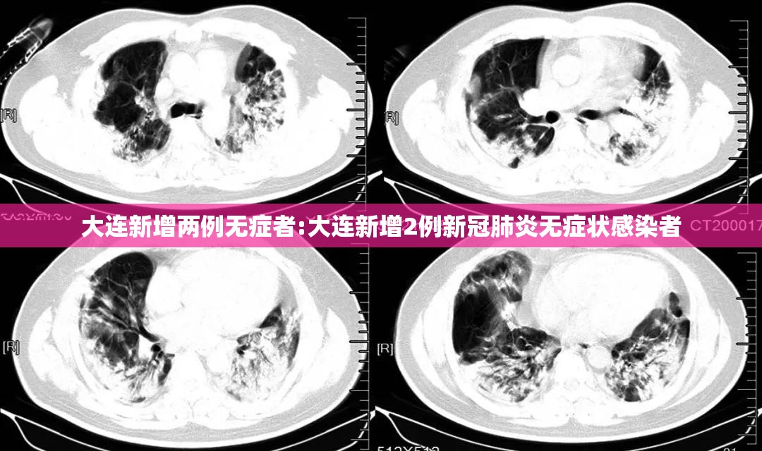大连新增两例无症者:大连新增2例新冠肺炎无症状感染者