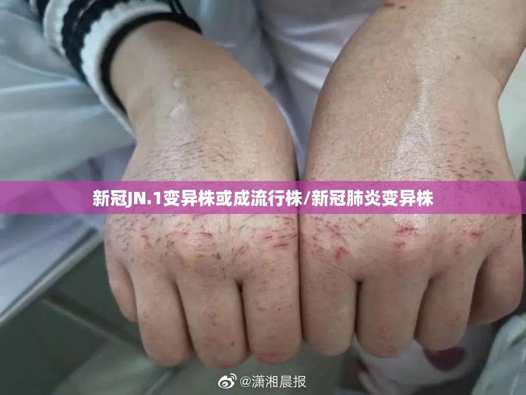 新冠JN.1变异株或成流行株/新冠肺炎变异株