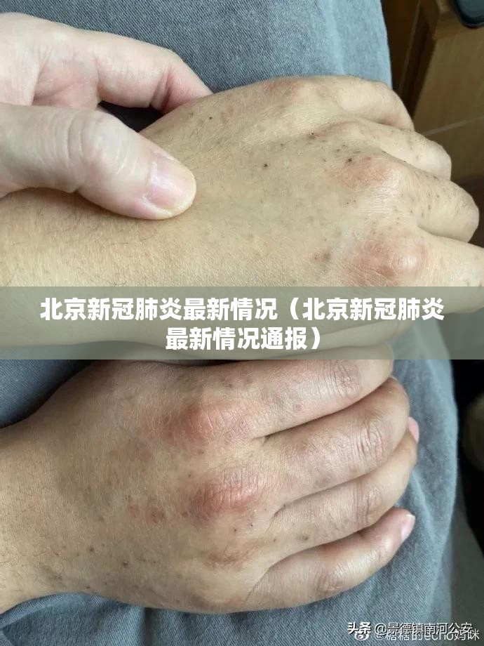 北京新冠肺炎最新情况(北京新冠肺炎最新情况通报) 北京新冠肺炎最新情况(北京新冠肺炎最新情况通报)
