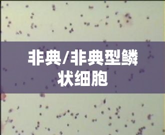 非典/非典型鳞状细胞 非典/非典型鳞状细胞