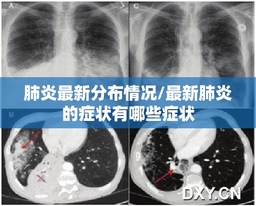 肺炎最新分布情况/最新肺炎的症状有哪些症状 肺炎最新分布情况/最新肺炎的症状有哪些症状